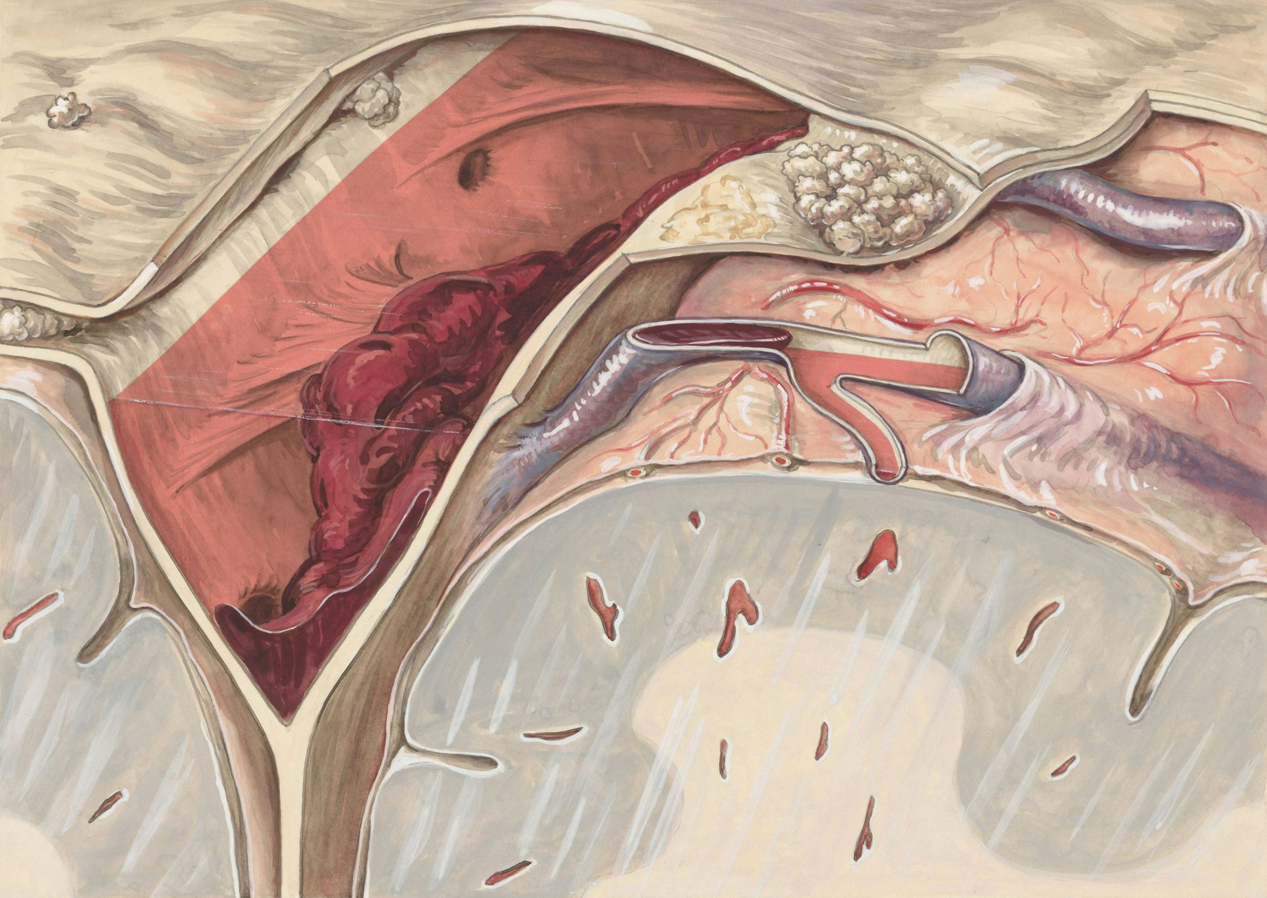 What is a perianal hematoma? What to know